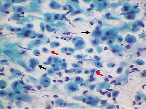 atrophic pattern pap smear|pap cellular changes atrophy.